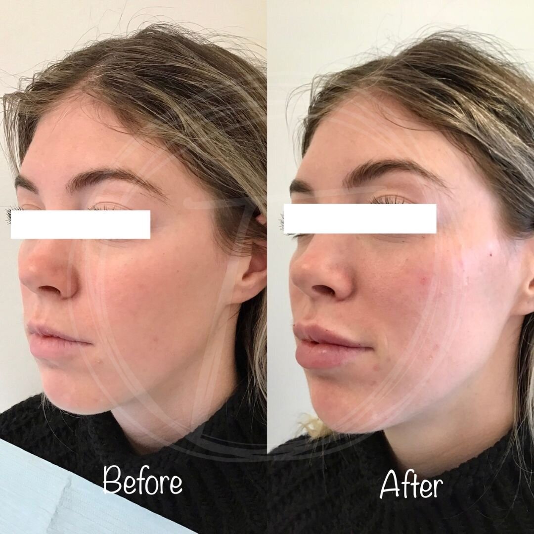 before:after results with look timeless - 1