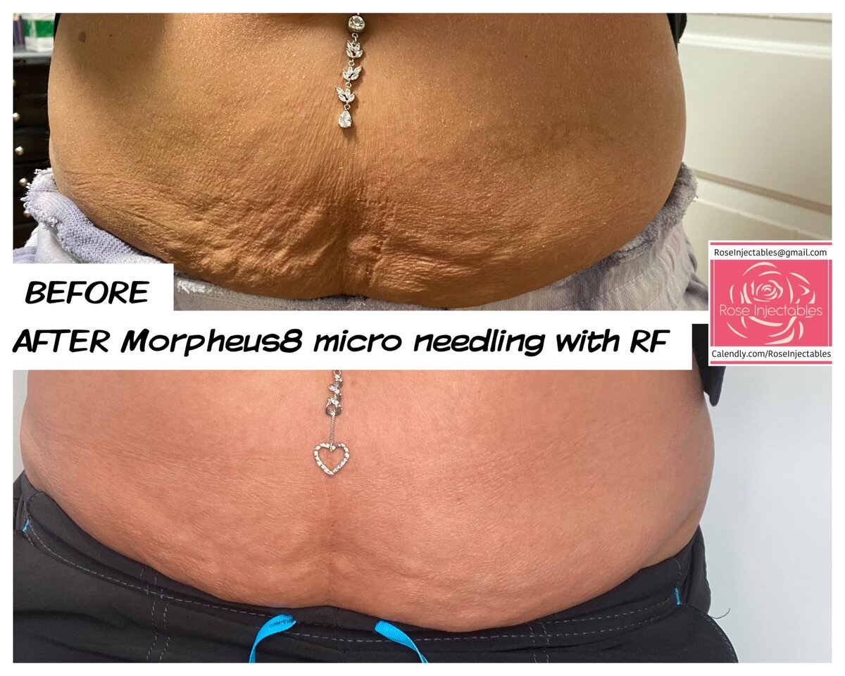 Morpheus8-by-Rose-Injectables-Before-and-After-Photos-40