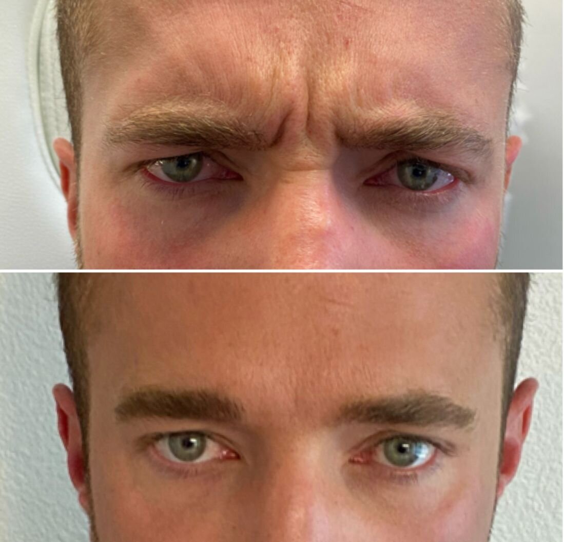 compressed-Neuromodulator-before-after-16