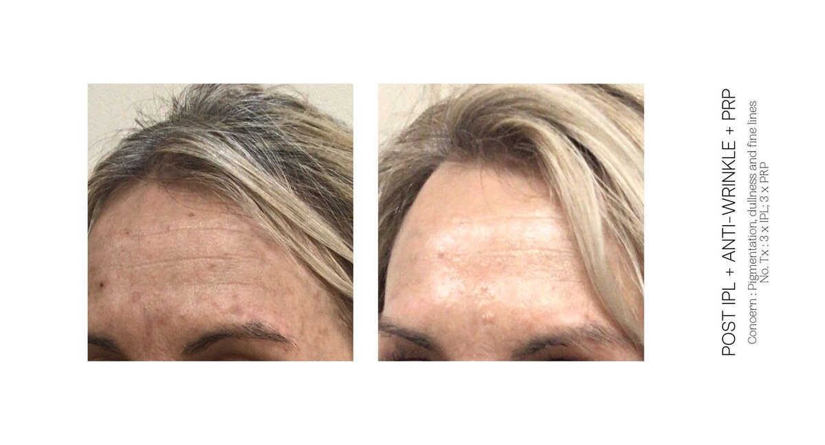 Skin Pigmentation and Fine Line Before and After 4