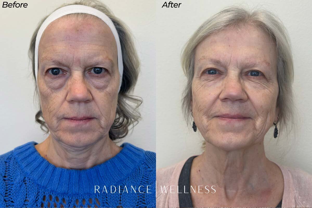 Facial-Balancing-BNA-6