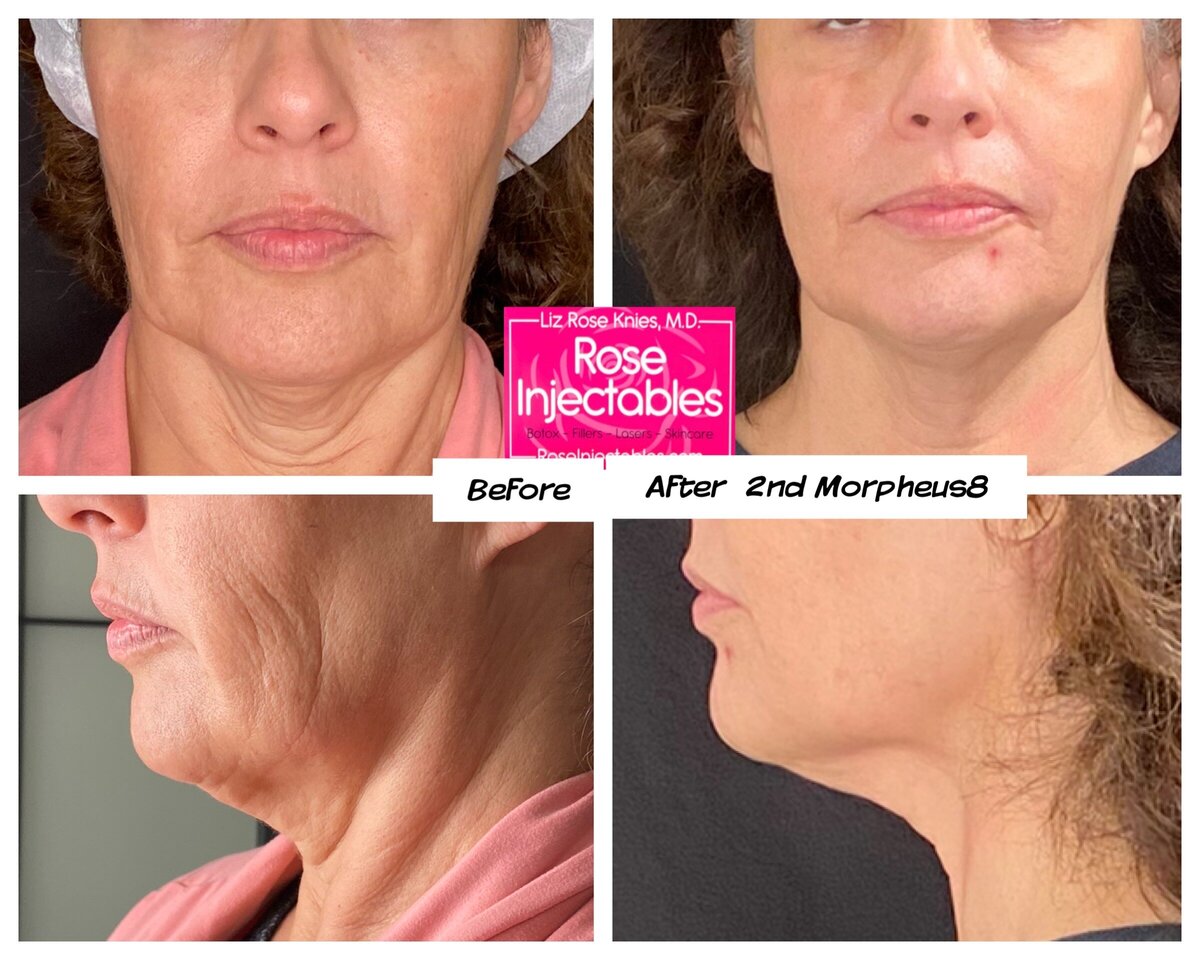 Morpheus8-by-Rose-Injectables-Before-and-After-Photos-58