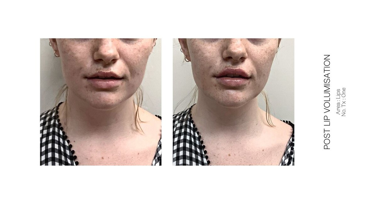 Best South Coast Lip Injection Before and After 10