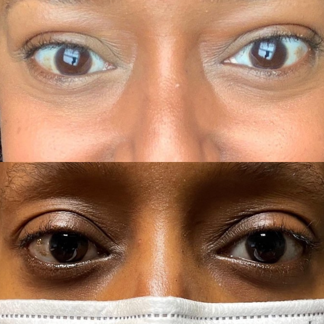 Thyroid Eye Disease. Before and after Tepezza infusions