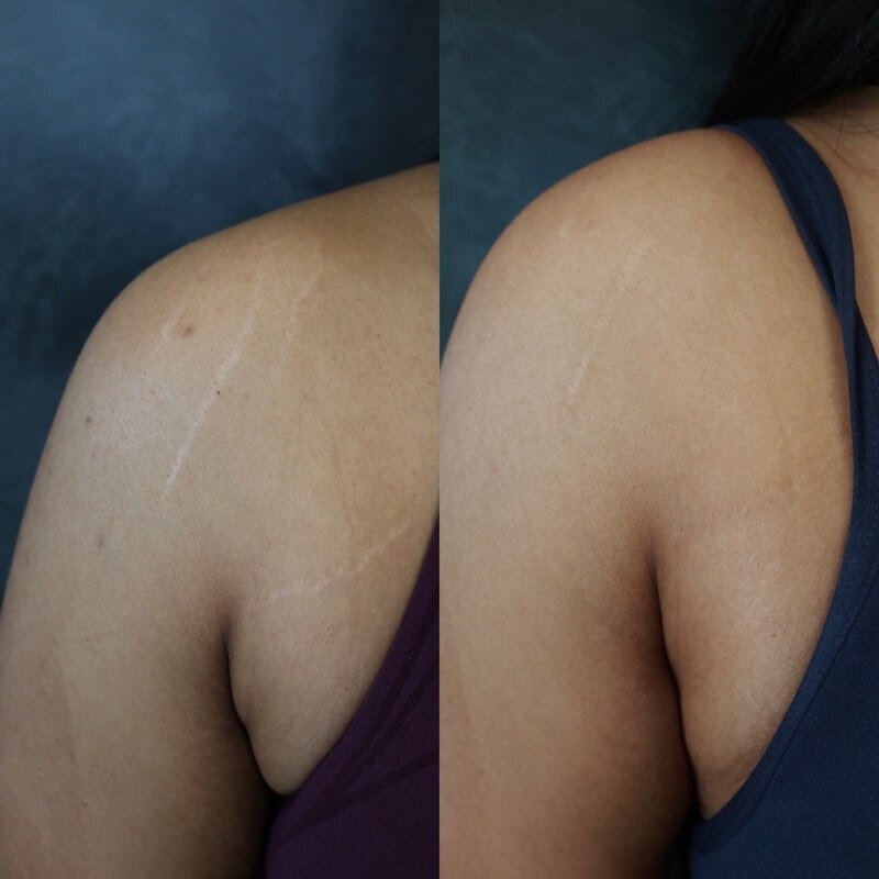 woman-of-color-stretch-marks