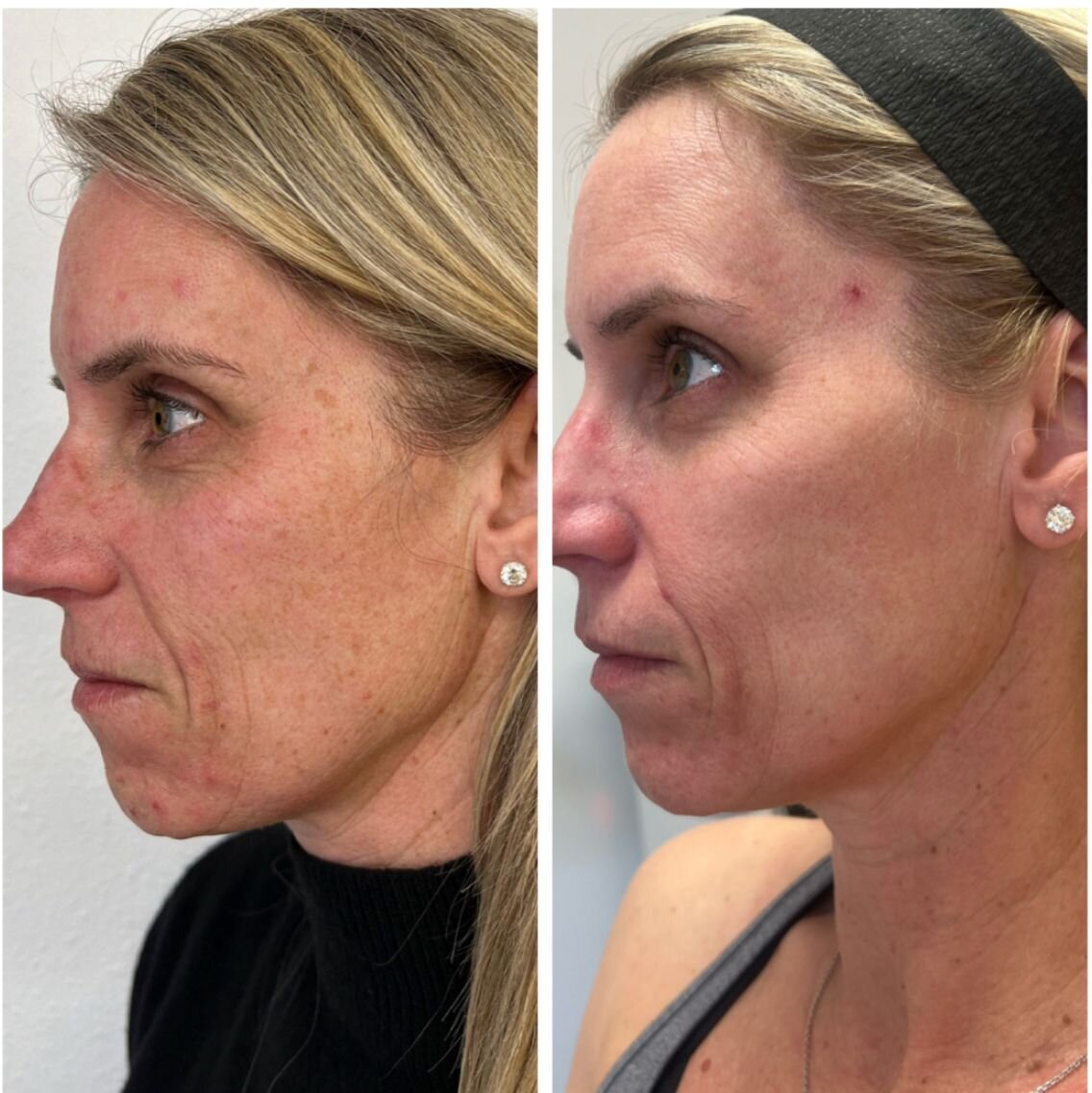 compressed-missing-laser-images-before-after-05