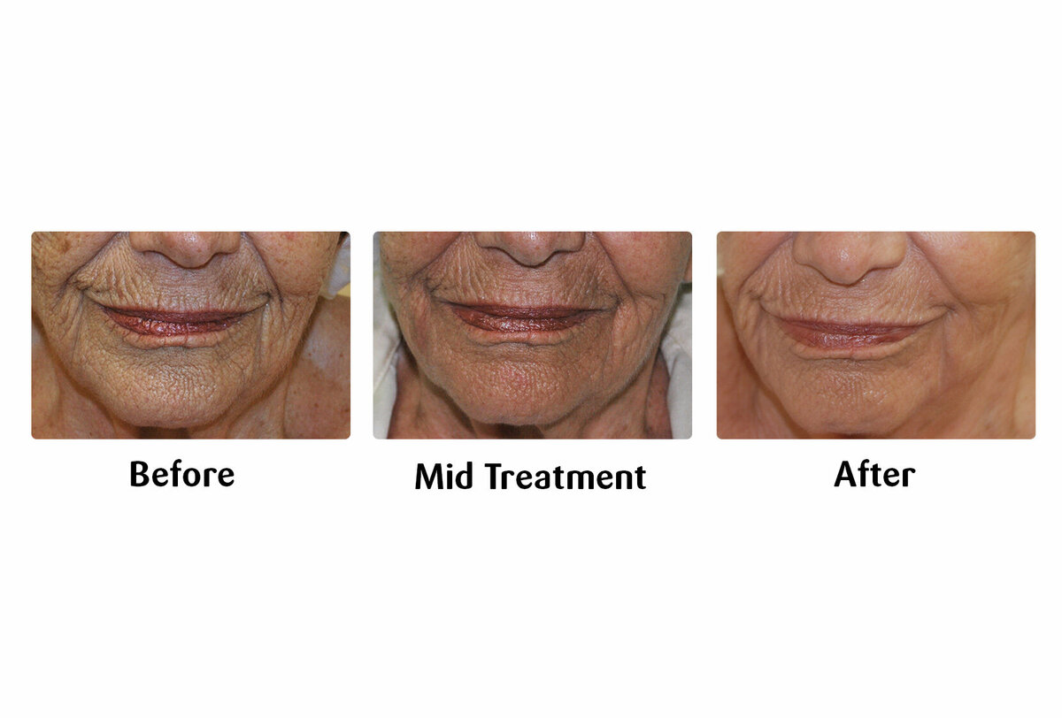Li Medical Aesthetics Skin Tightening with VST Sinclair Before and After3