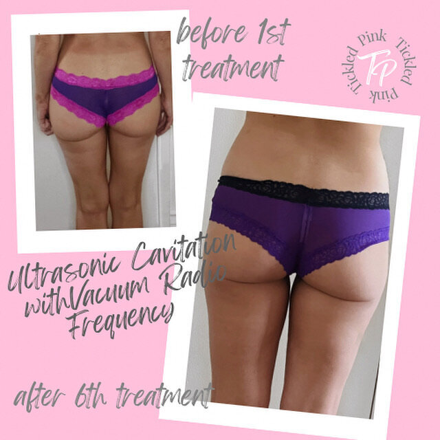 butt sculpt before and after