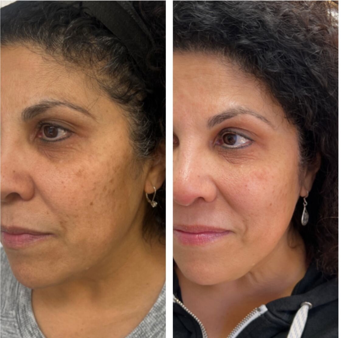 bbl-before-after-14