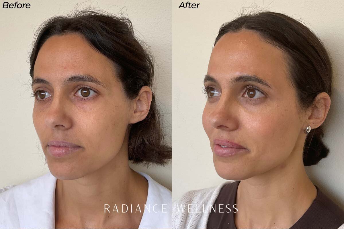 Facial-Balancing-BNA-5