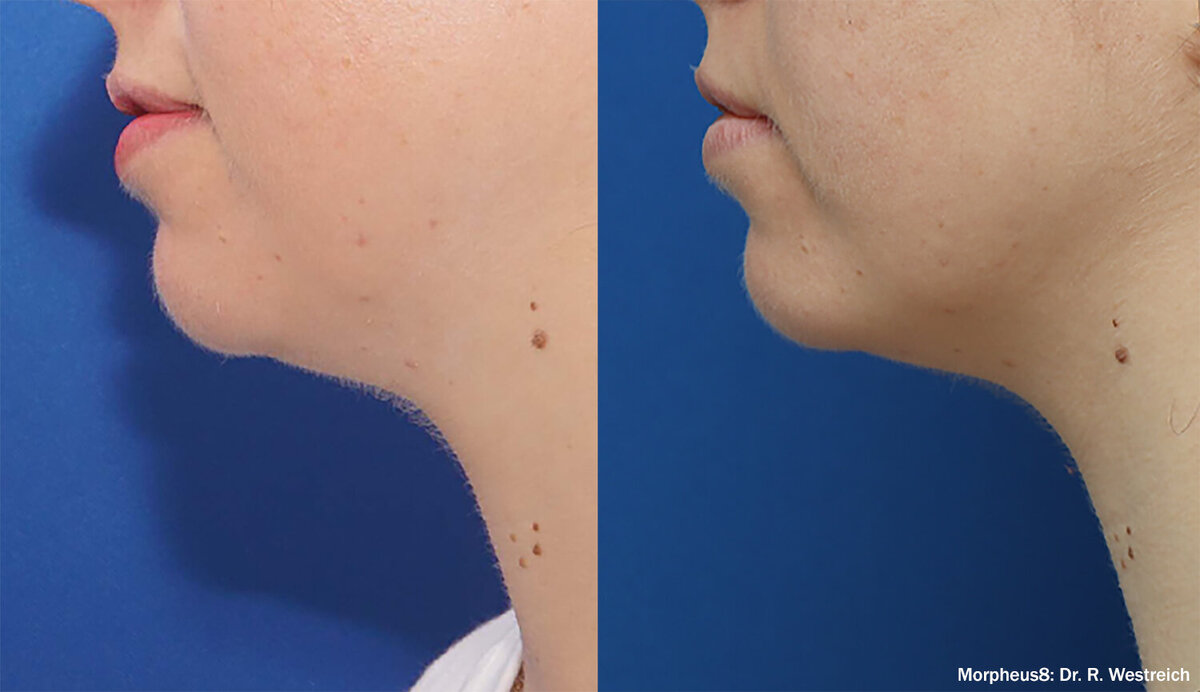 morpheus8-before-after-dr-r-westreich-preview-4