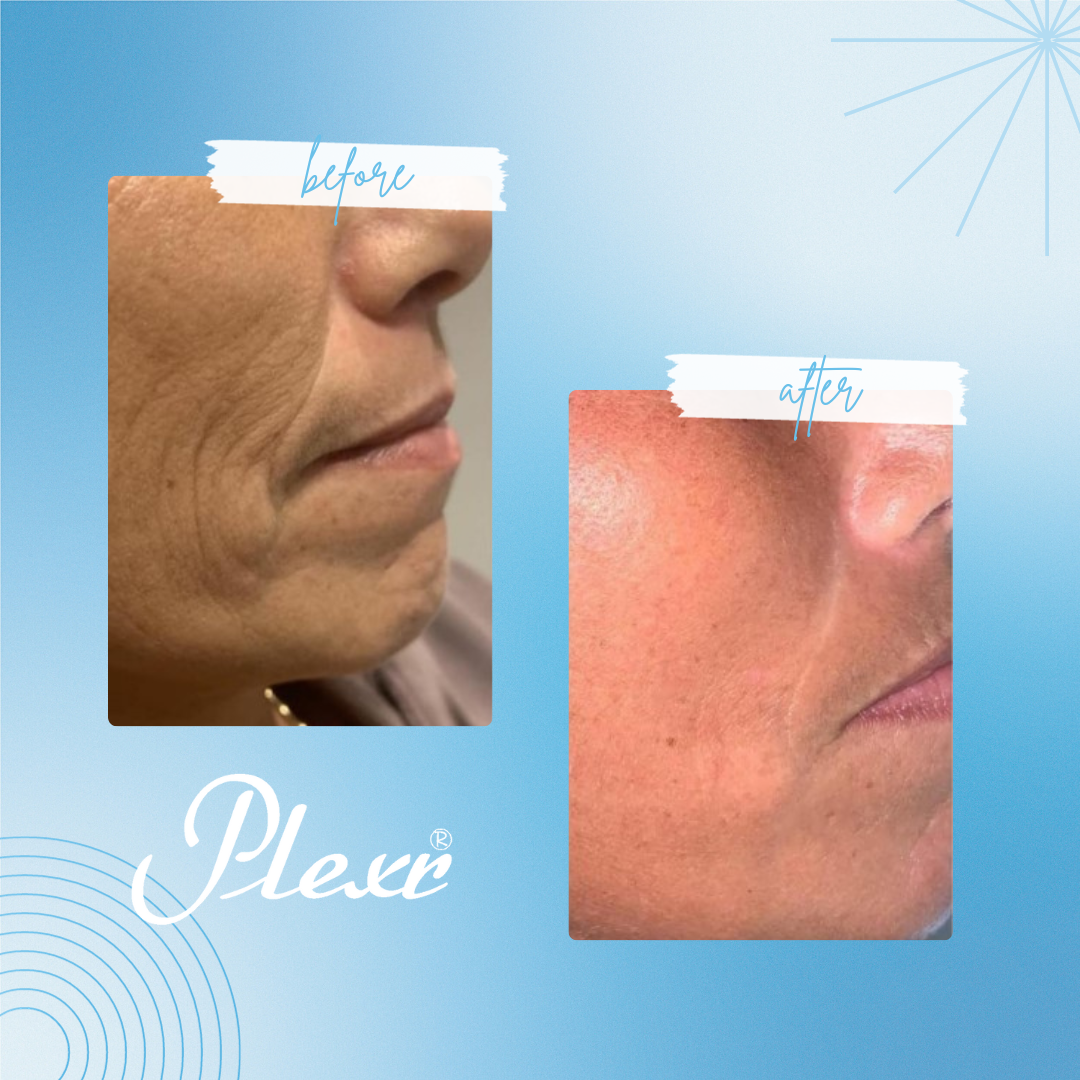 Wrinkle Reduction Selected