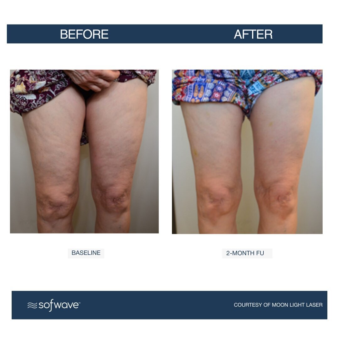 Set-80-Cellulite