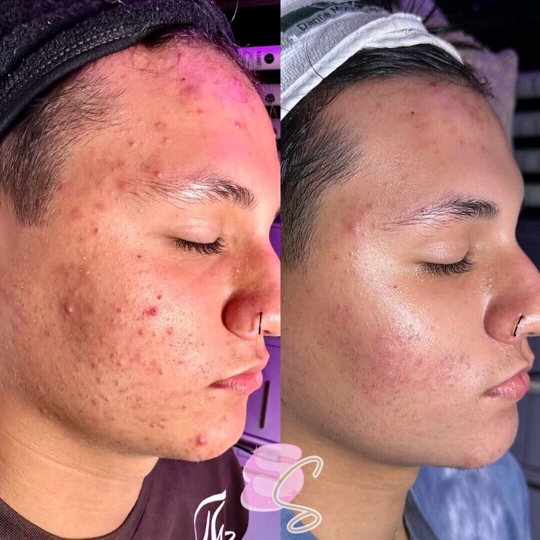 Acne boot camp before and after