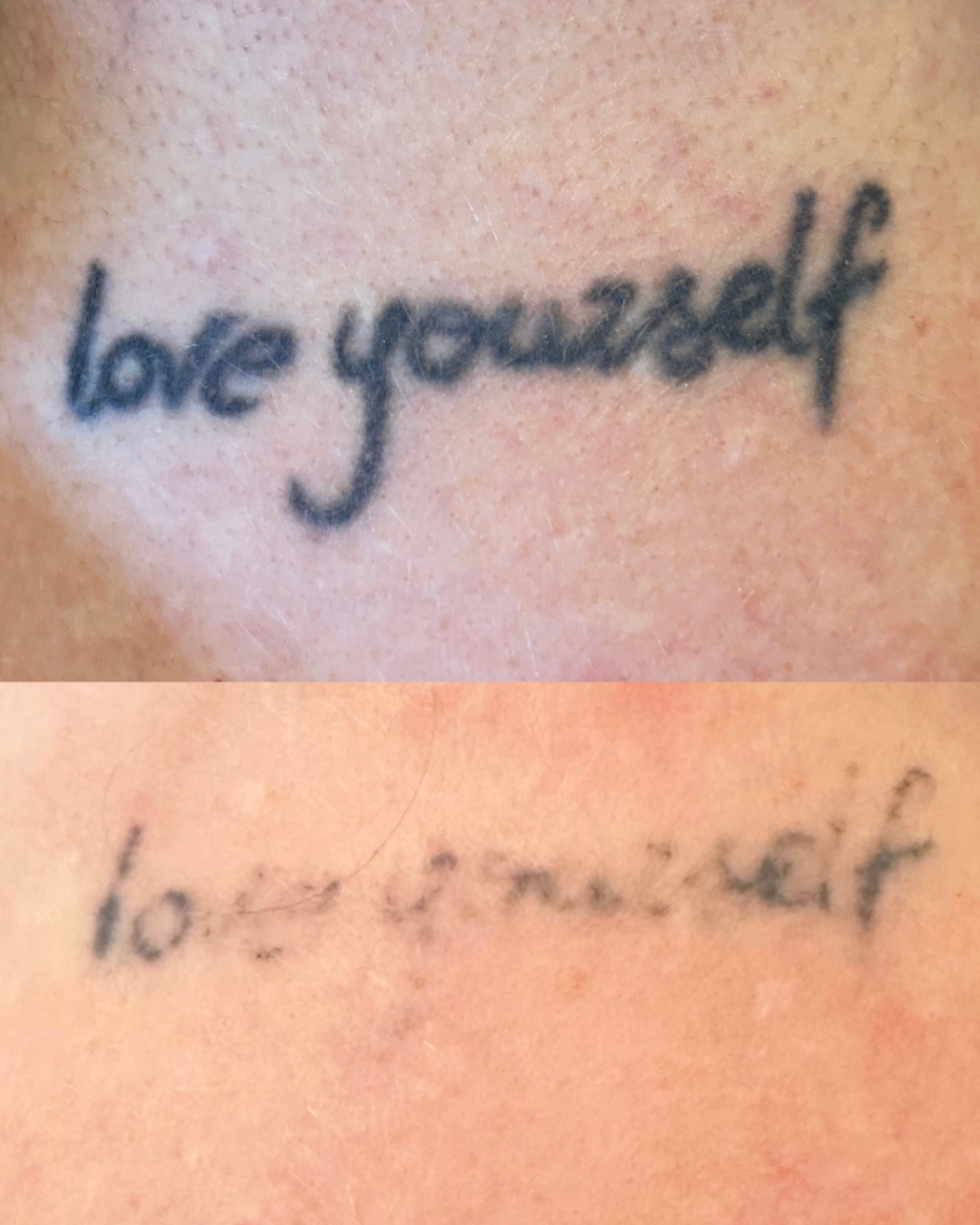 Resultaat Cloud Aesthetics Tatoeage Verwijderen