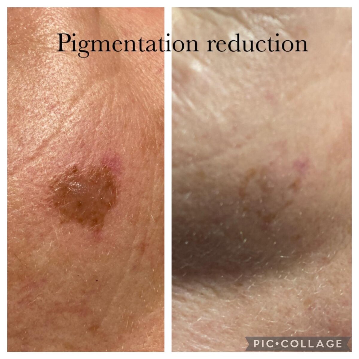 pigmentation reduction in norwich based clinic aesthetic practitioner