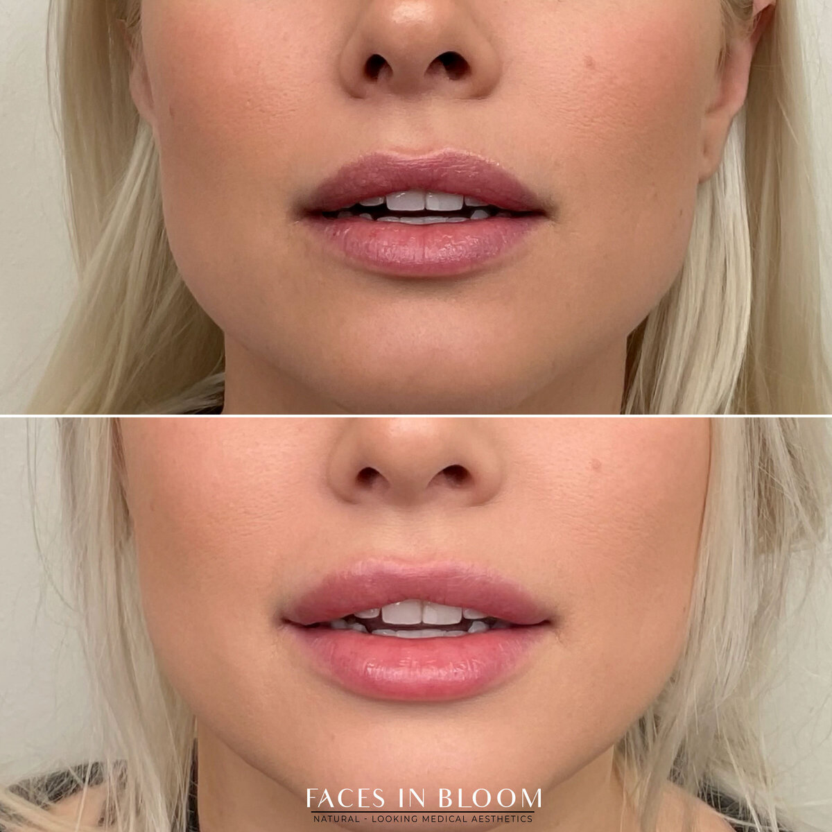 FACESINBLOOM_BEFOREAFTER_LIPS_06