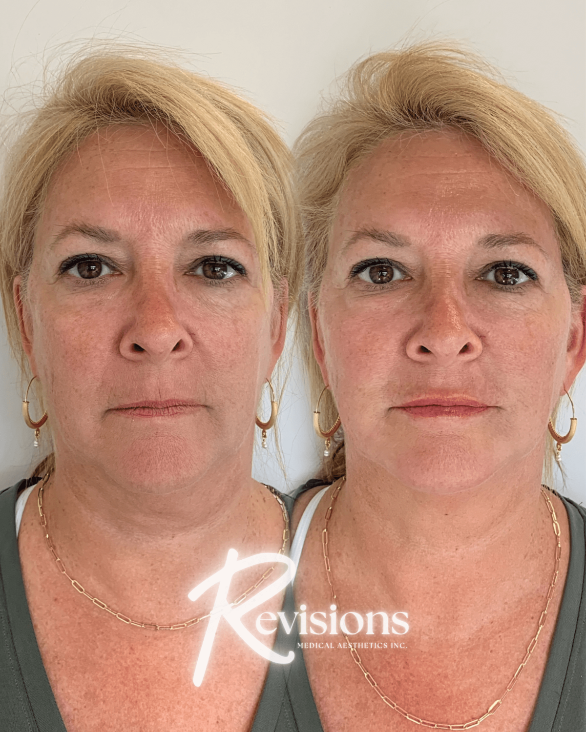 Dermal_Fillers_Lip_Cheek_Filler_Face_Rejuvenation_in_Ottawa (1)