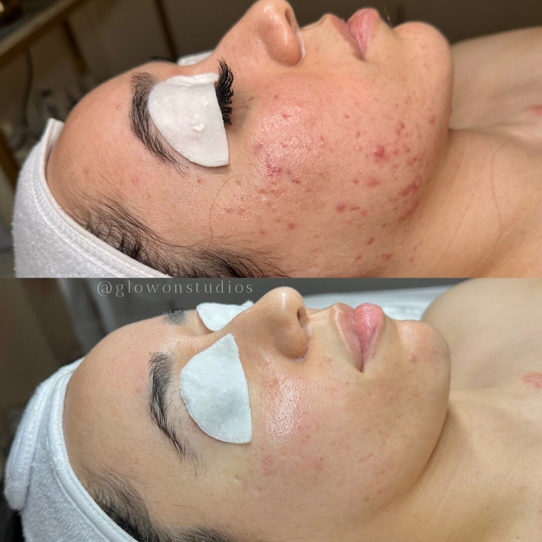 Glow-On-Studios-Before-After-Skincare-Sacramento-14