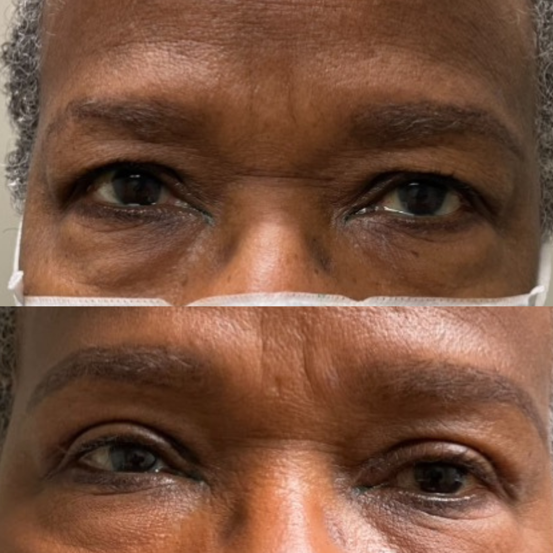 Before and after Blepharoplasty