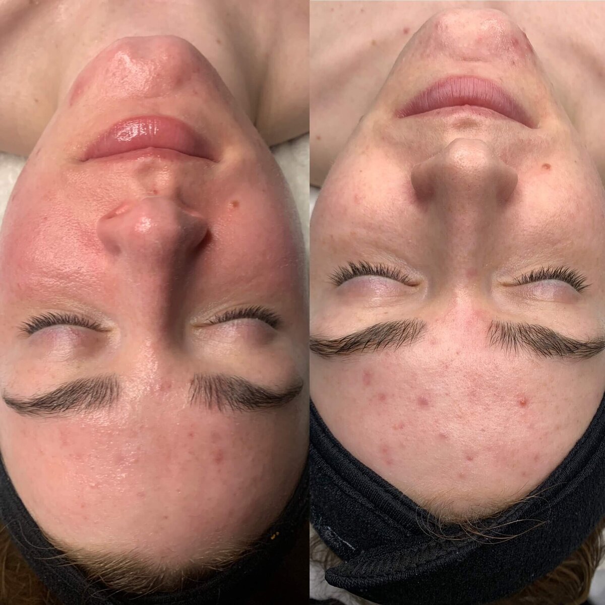 Acne B&A Results