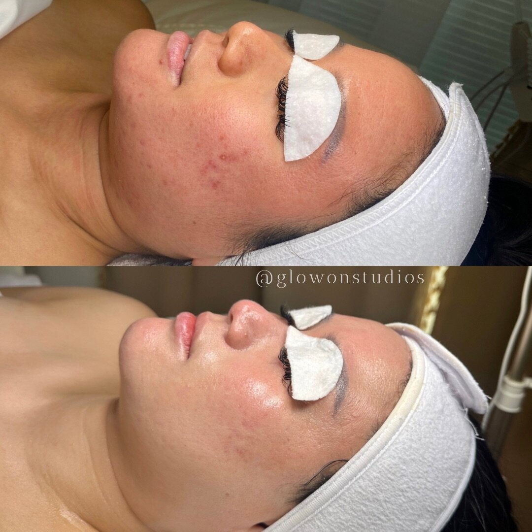 Glow-On-Studios-Before-After-Skincare-Sacramento-9