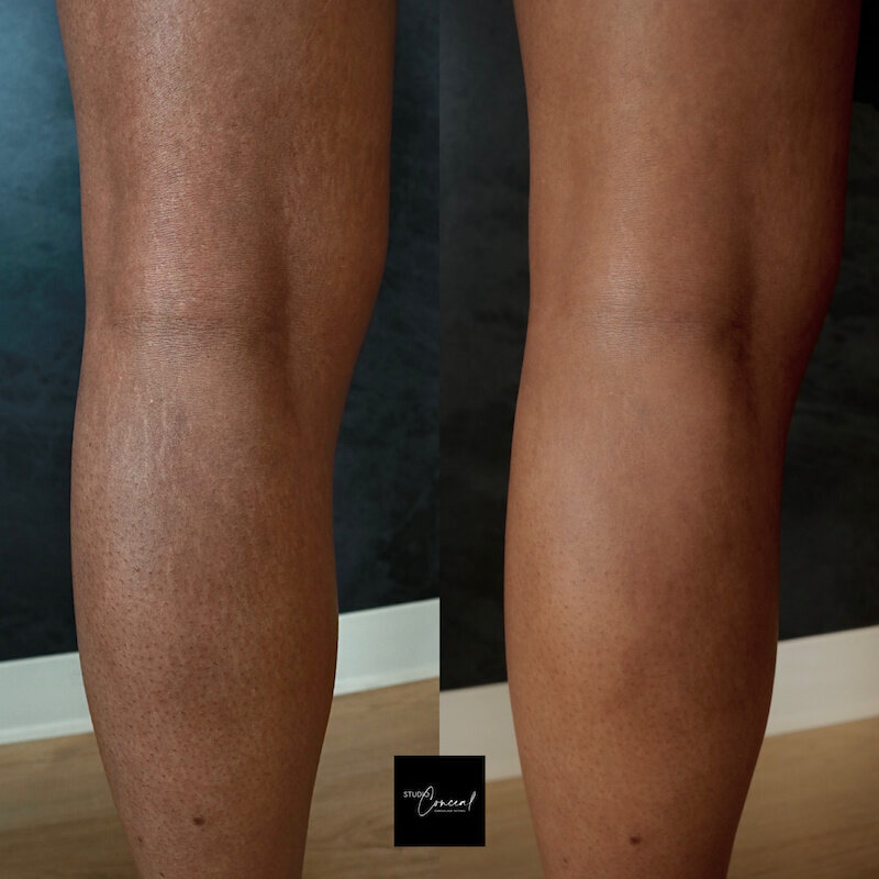 black-skin-stretch-mark-cover-up-tattoo