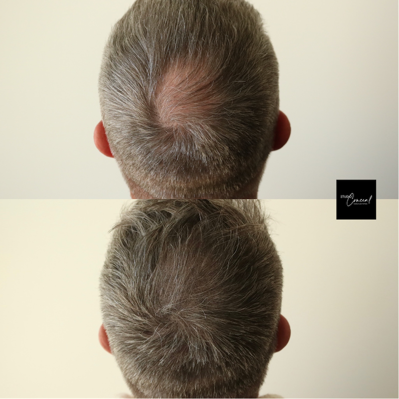 Hair-Loss-Density-Tattoo-3