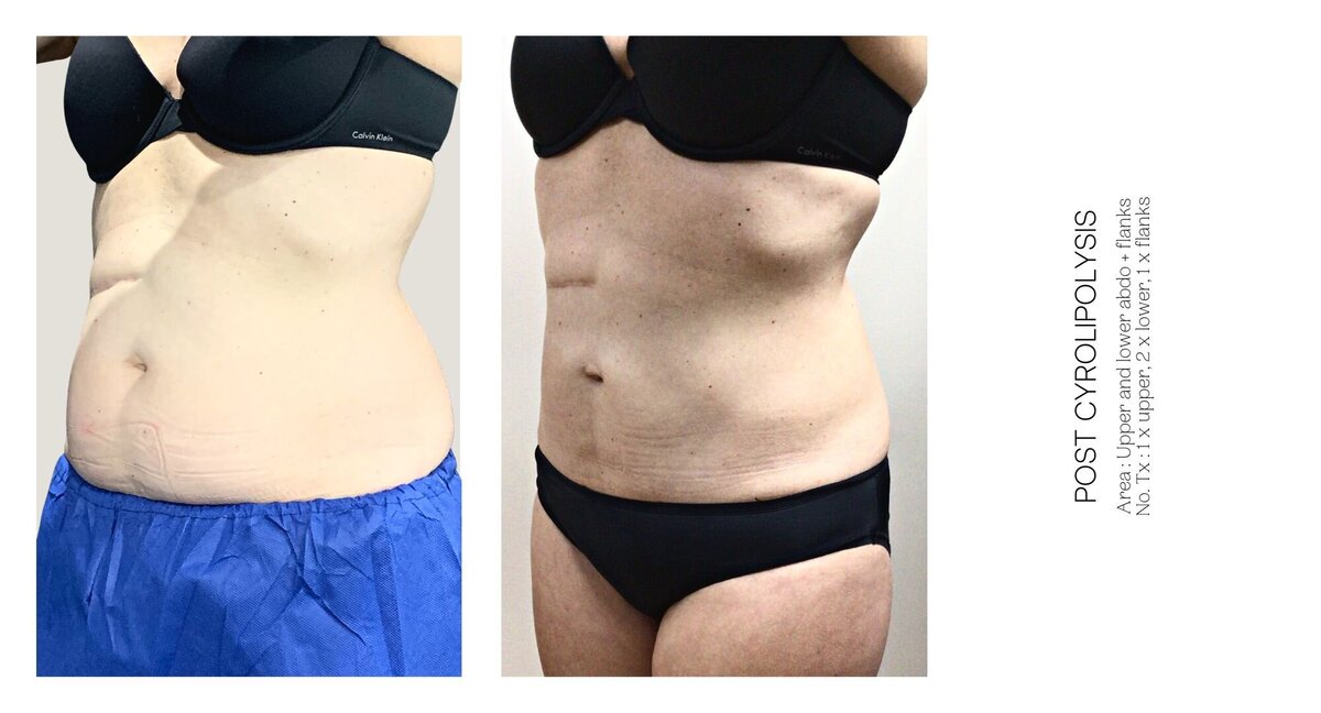 Cryolipolysis Stomach Before and After 1
