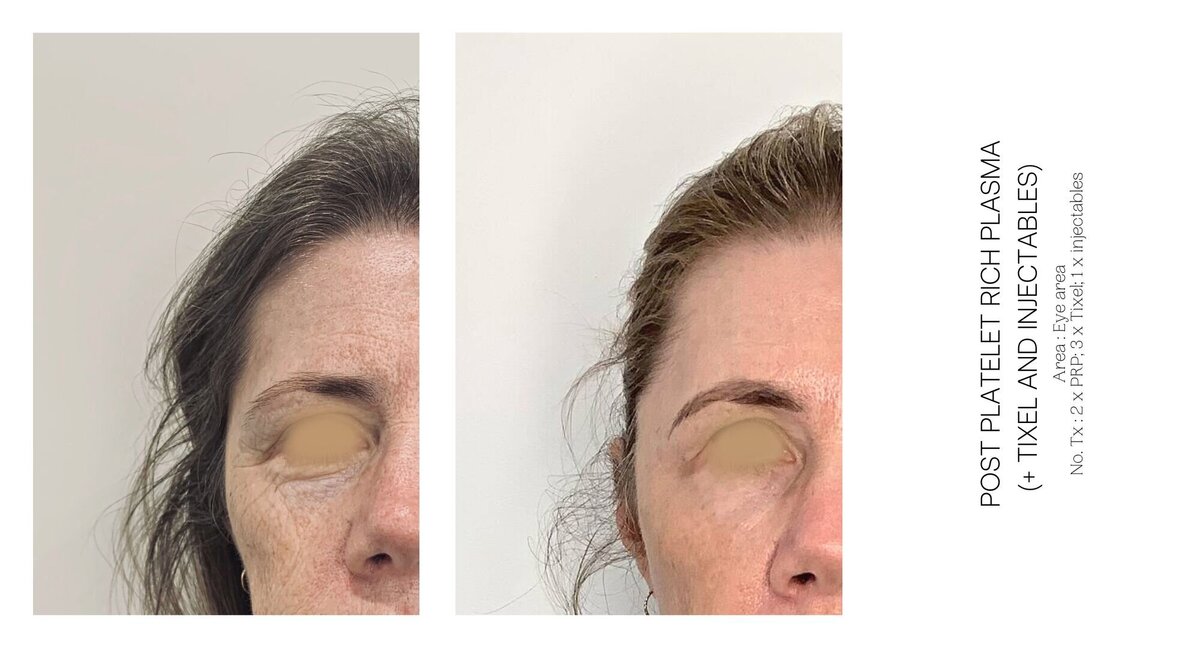 PRP Under Eye Before and After 1