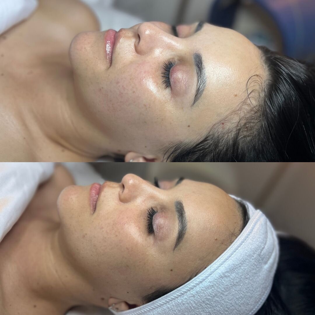 compressed-High-Touch-Medical-Grade-Facials-brand-and b-a-03