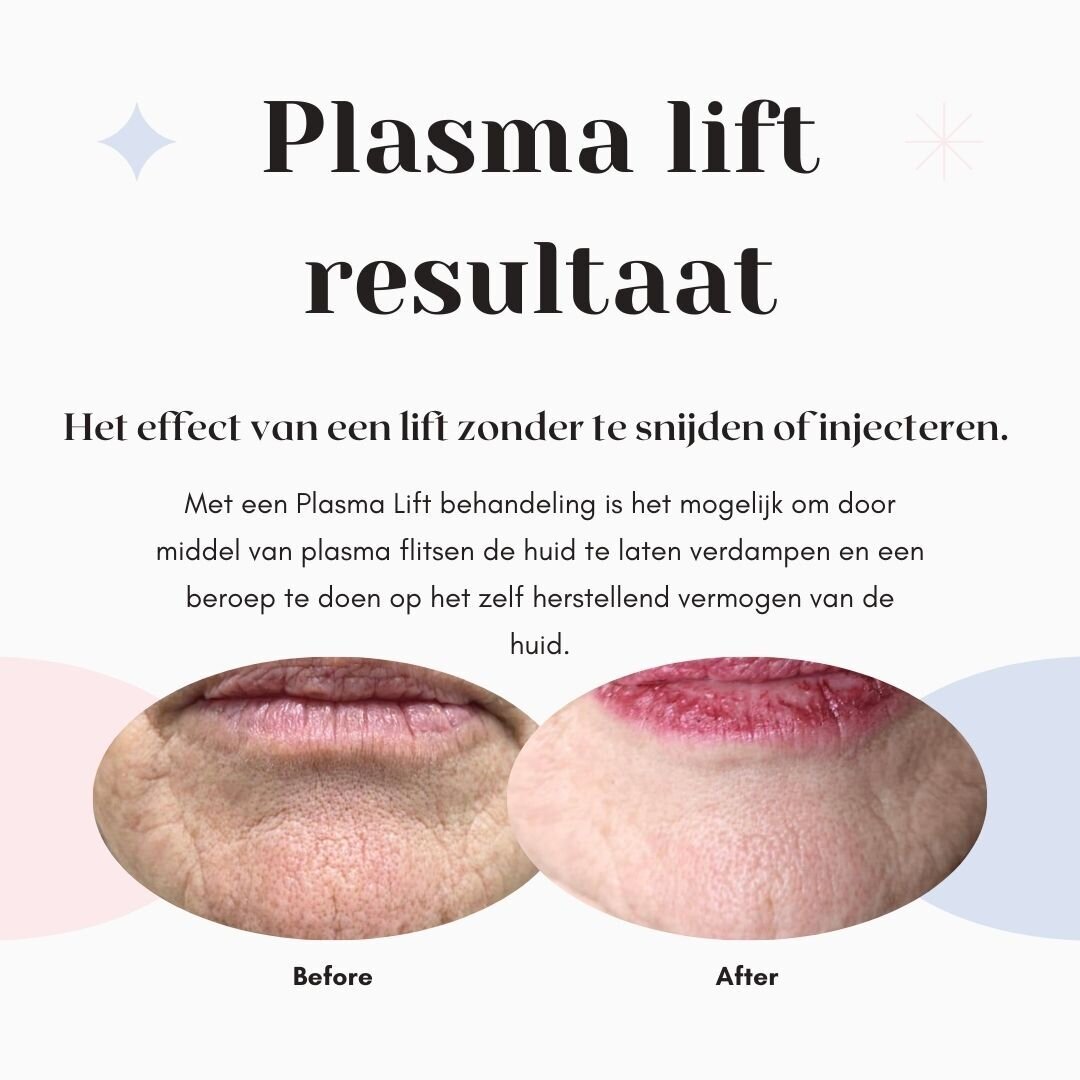 Before_after Plasma Lift-4