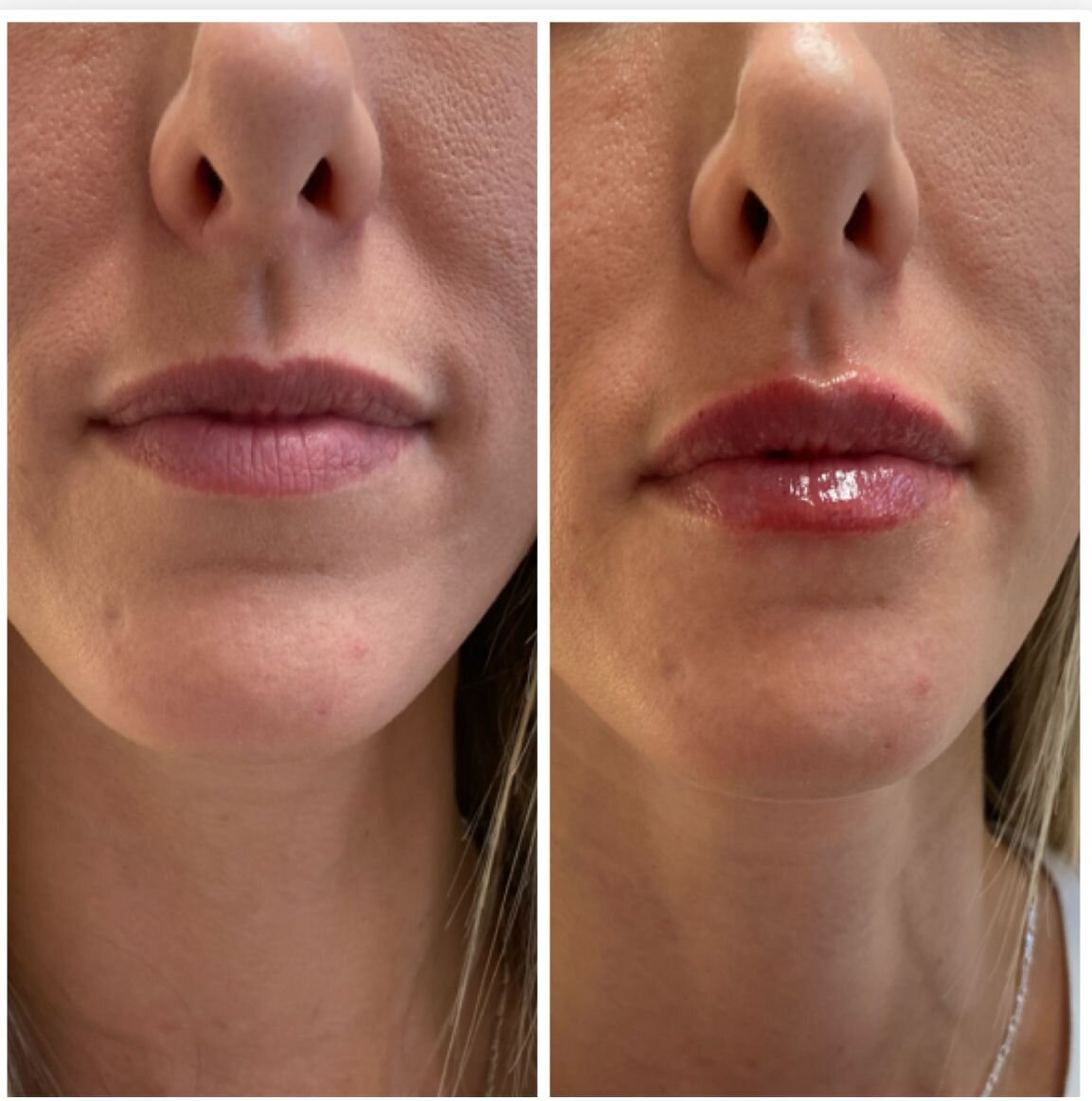 compressed-Lip-Wrinkles- Lip-volume-nd-some-brand-pics-30