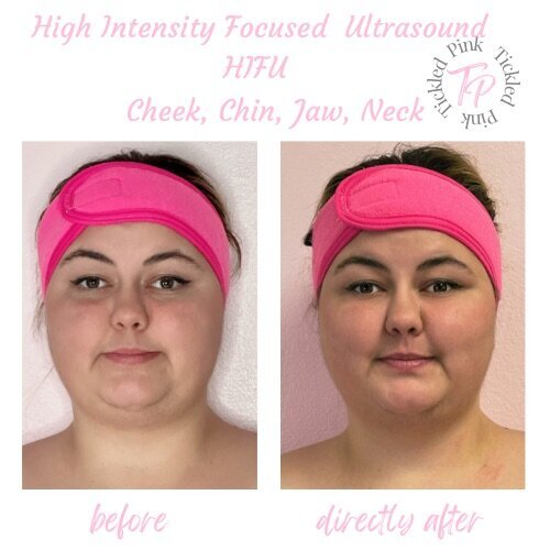 tickled pink aesthetics HIFU before and after