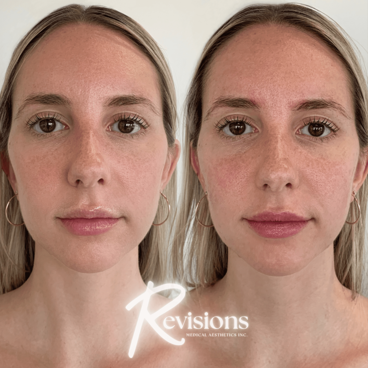 Best_Dermal_Filler_for_Face_in_Ottawa (1)