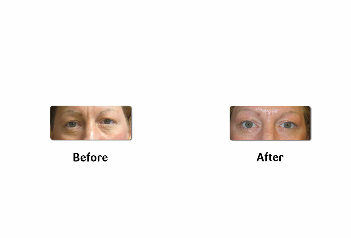 Li Medical Aesthetics Skin Tightening with VST Sinclair Before and After2