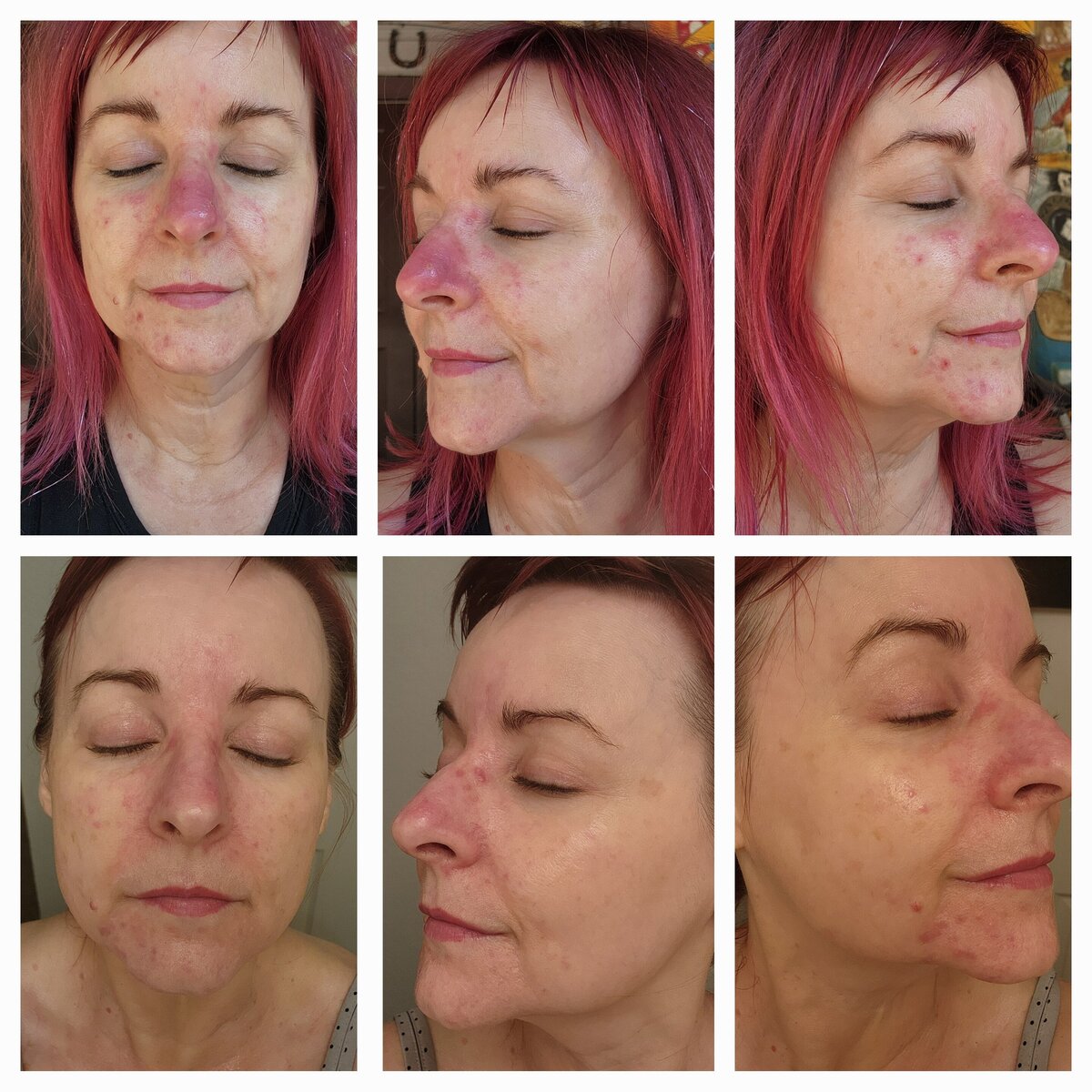 Before and after showing smoother, healthier nose skin after addressing phymatous rosacea naturally