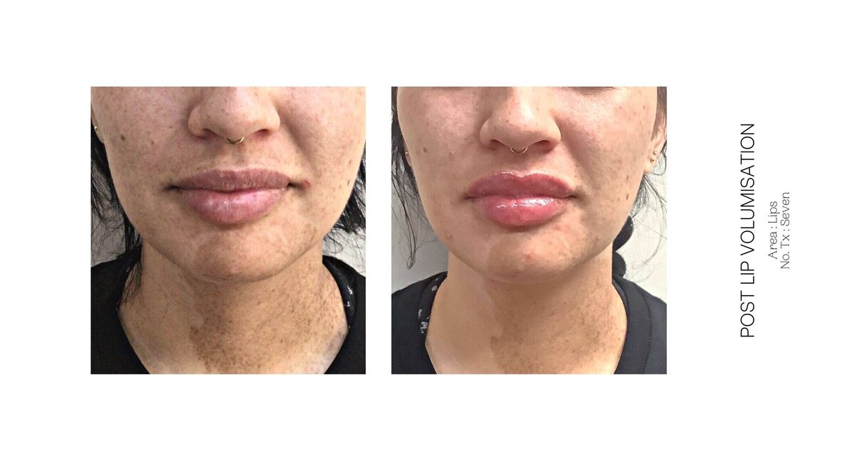 Best South Coast Lip Injection Before and After 60