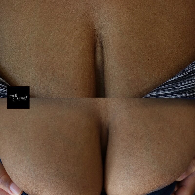 arizona-stretch-mark-removal-treatment