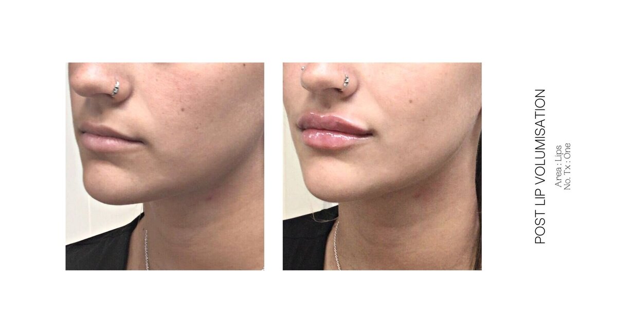 Best South Coast Lip Injection Before and After 31