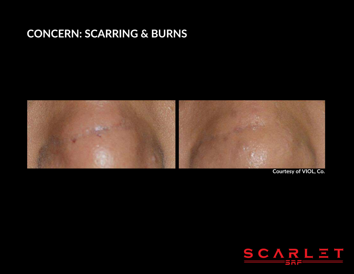 Scarlet BA 8