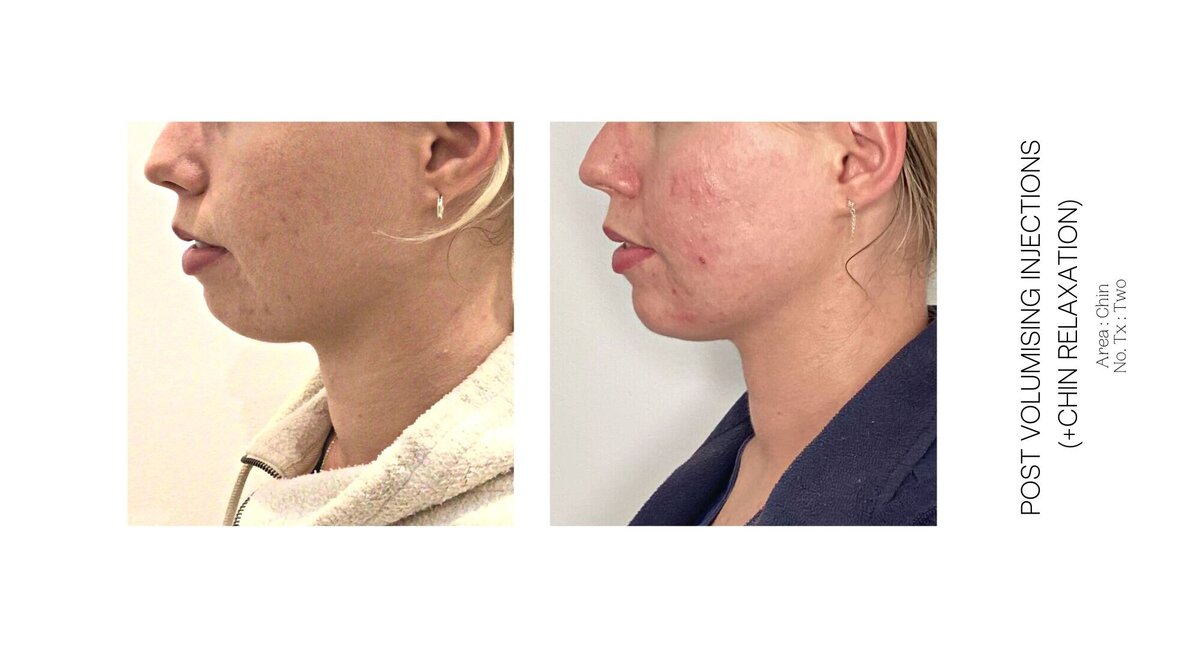 Chin Injections Before and After 6