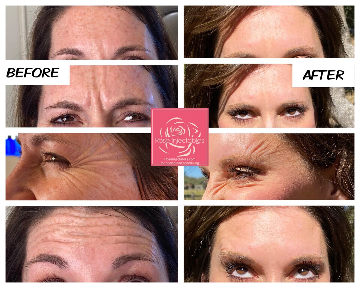Botox-by-Rose-Injectables-Before-and-After-Photos-4