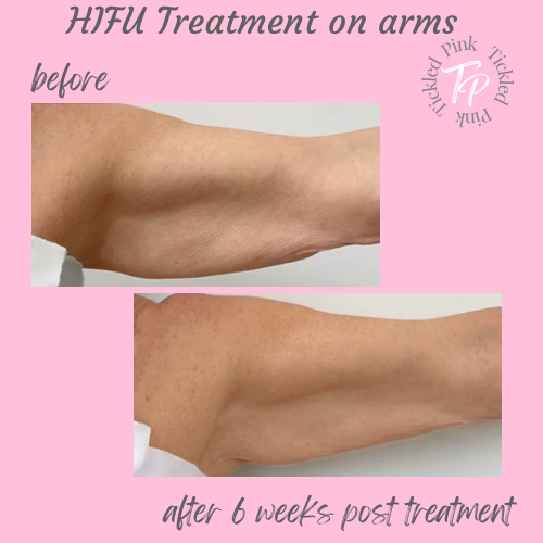 HIFU treatment on arm before and after photos