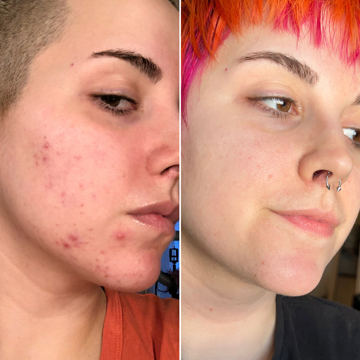 Acne Facial Sacramento