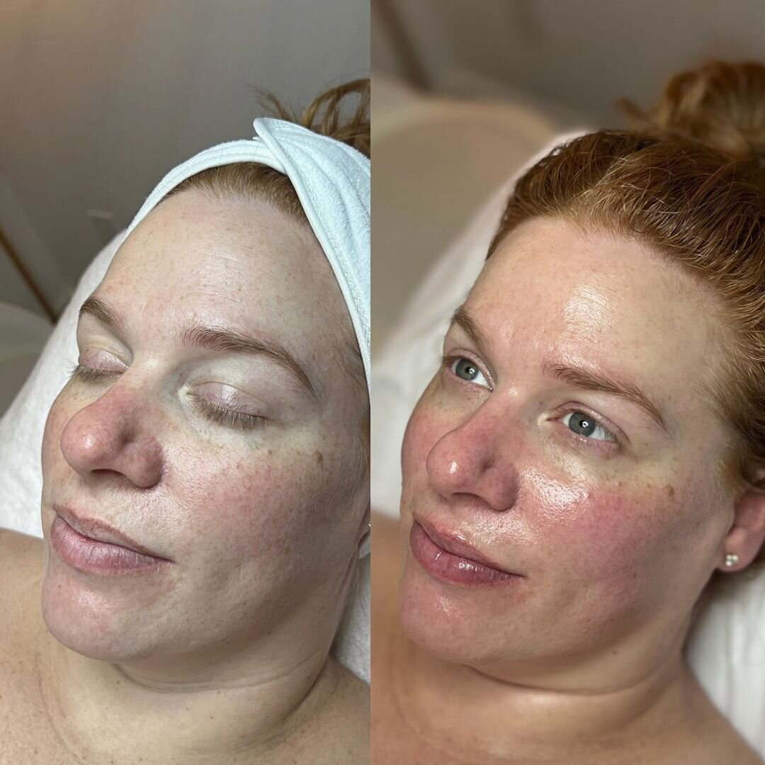 compressed-High-Touch-Medical-Grade-Facials-brand-and b-a-05