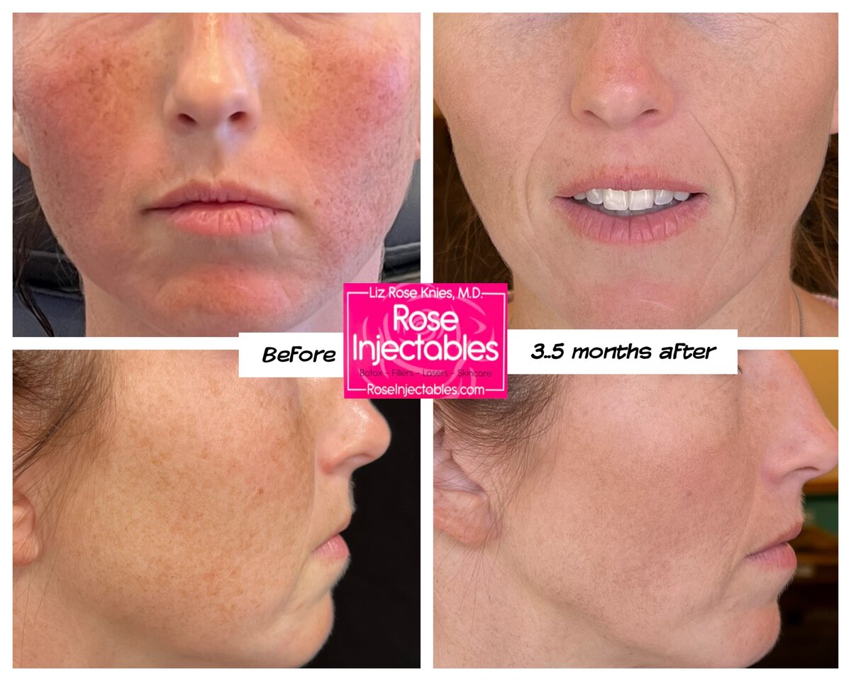 Lumecca-by-Rose-Injectables-Dark-Spot-Removal-Before-and-After-Photos-3