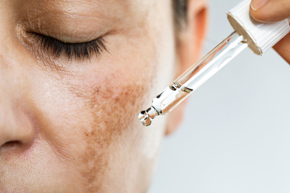 woman applying a healing oil to the melasma on her cheek