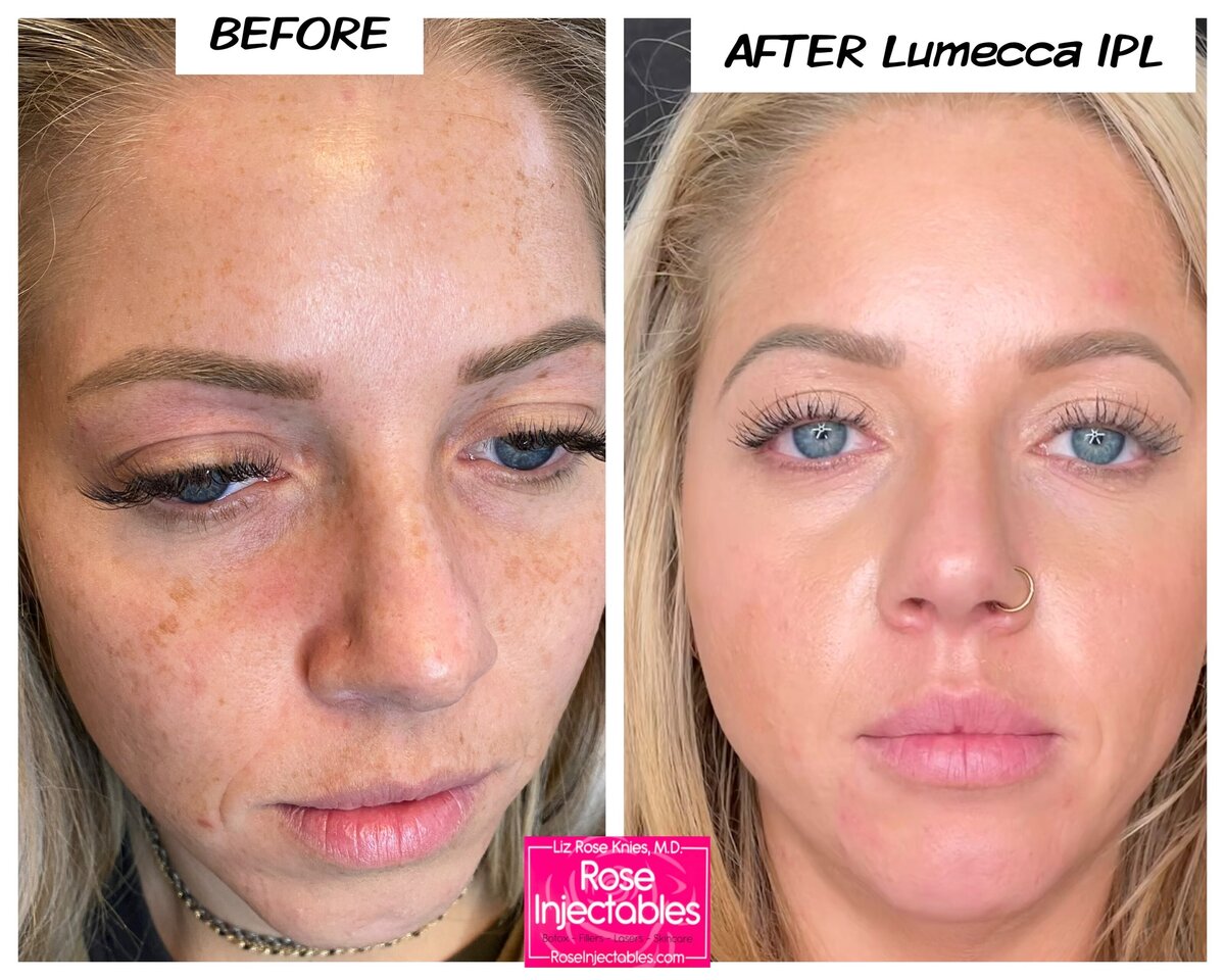 Lumecca-by-Rose-Injectables-Dark-Spot-Removal-Before-and-After-Photos-5