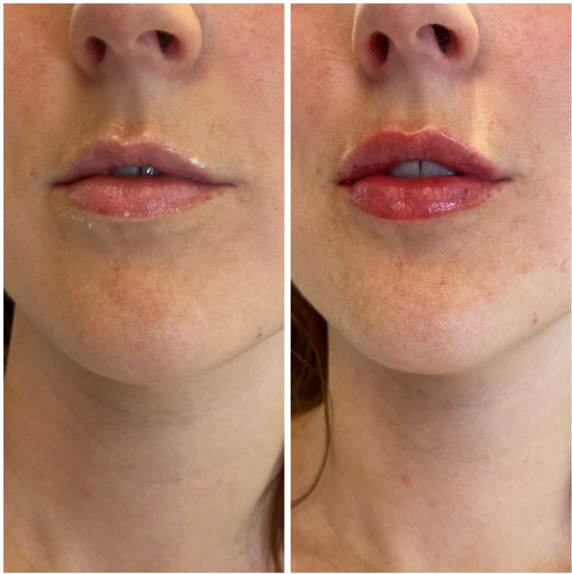 compressed-Lip-Wrinkles- Lip-volume-nd-some-brand-pics-22